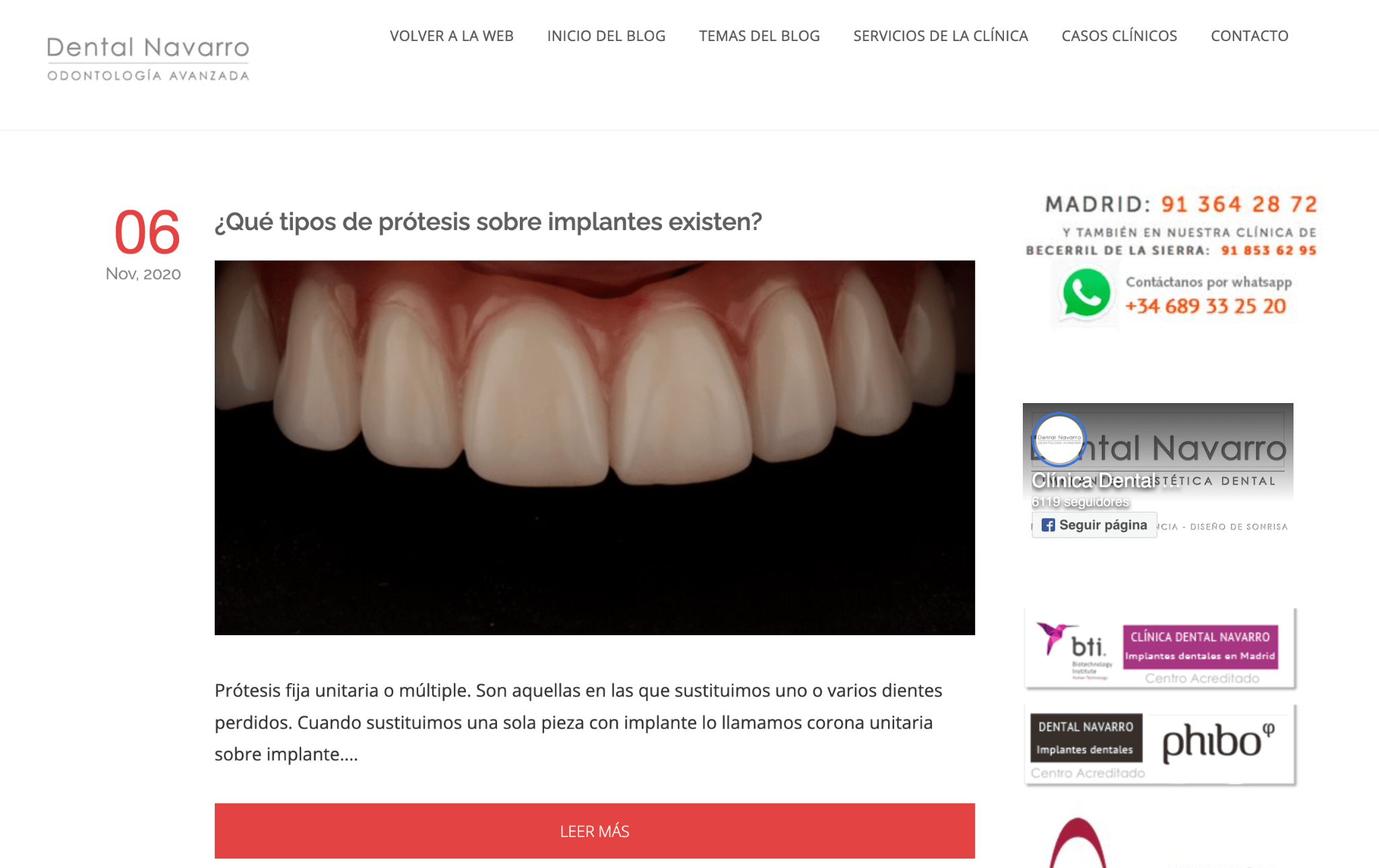 La pagina sobre los tipos de prótesis sobre implantes